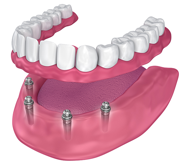 Wilmington All-on-4 Implants