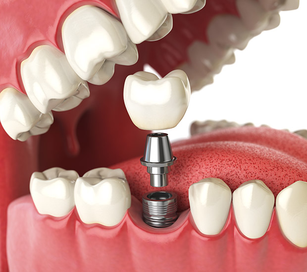 Wilmington Will I Need a Bone Graft for Dental Implants