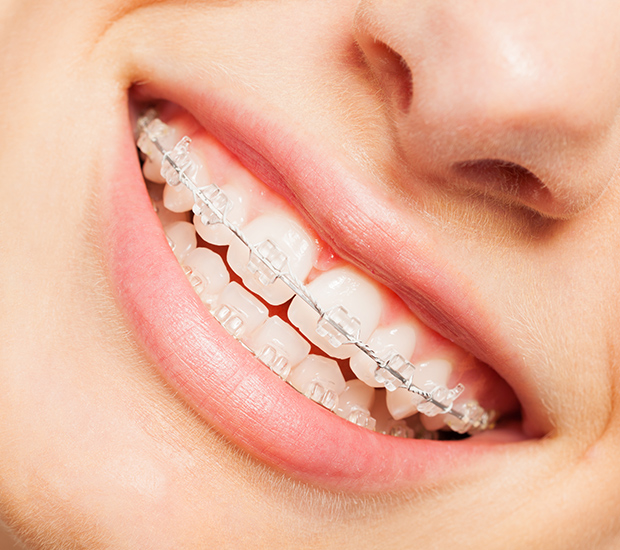 Wilmington Clear Braces