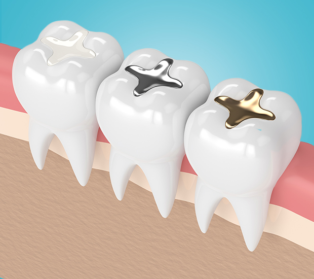 Wilmington Composite Fillings