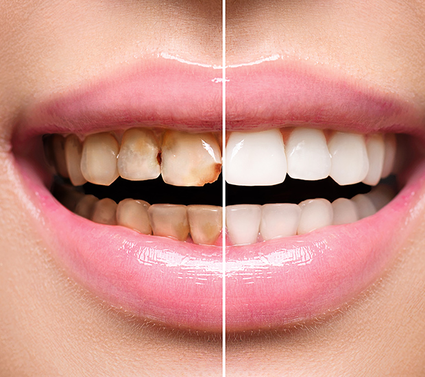 Wilmington Dental Implant Restoration