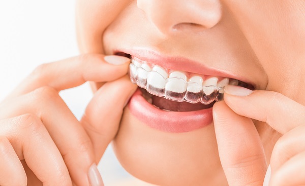 Tips For Using Invisalign