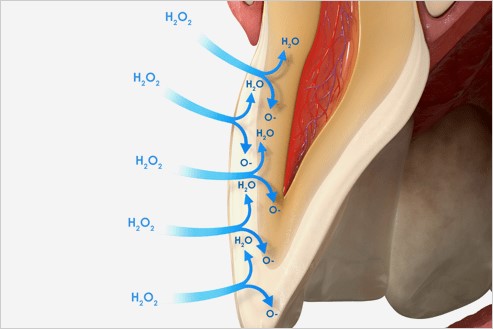 opalescece-teeth-whitening-process