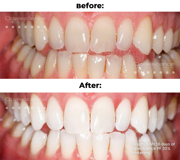 Wilmington Teeth Whitening